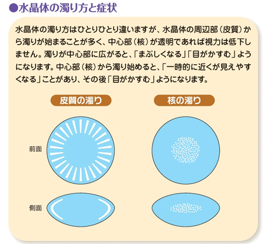 Fig7.白内障の症状