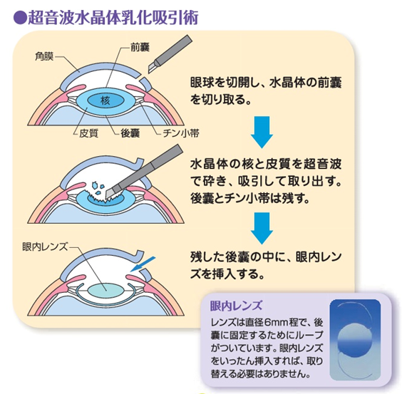 Fig9.白内障の手術