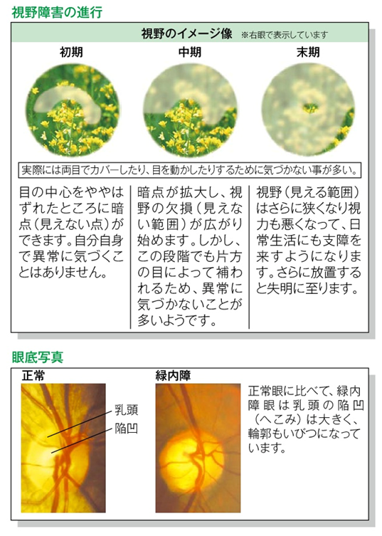 Fig2.視野障害の進行