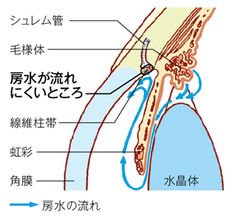 Fig3.原発開放隅角緑内障