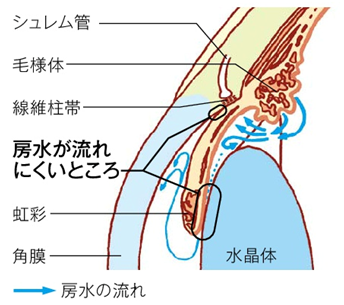 Fig4.原発開放隅角緑内障